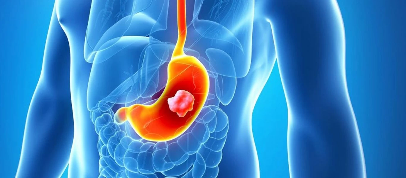 Καρκίνος στομάχου: Η διατροφική συνήθεια που διπλασιάζει τον κίνδυνο εμφάνισής του